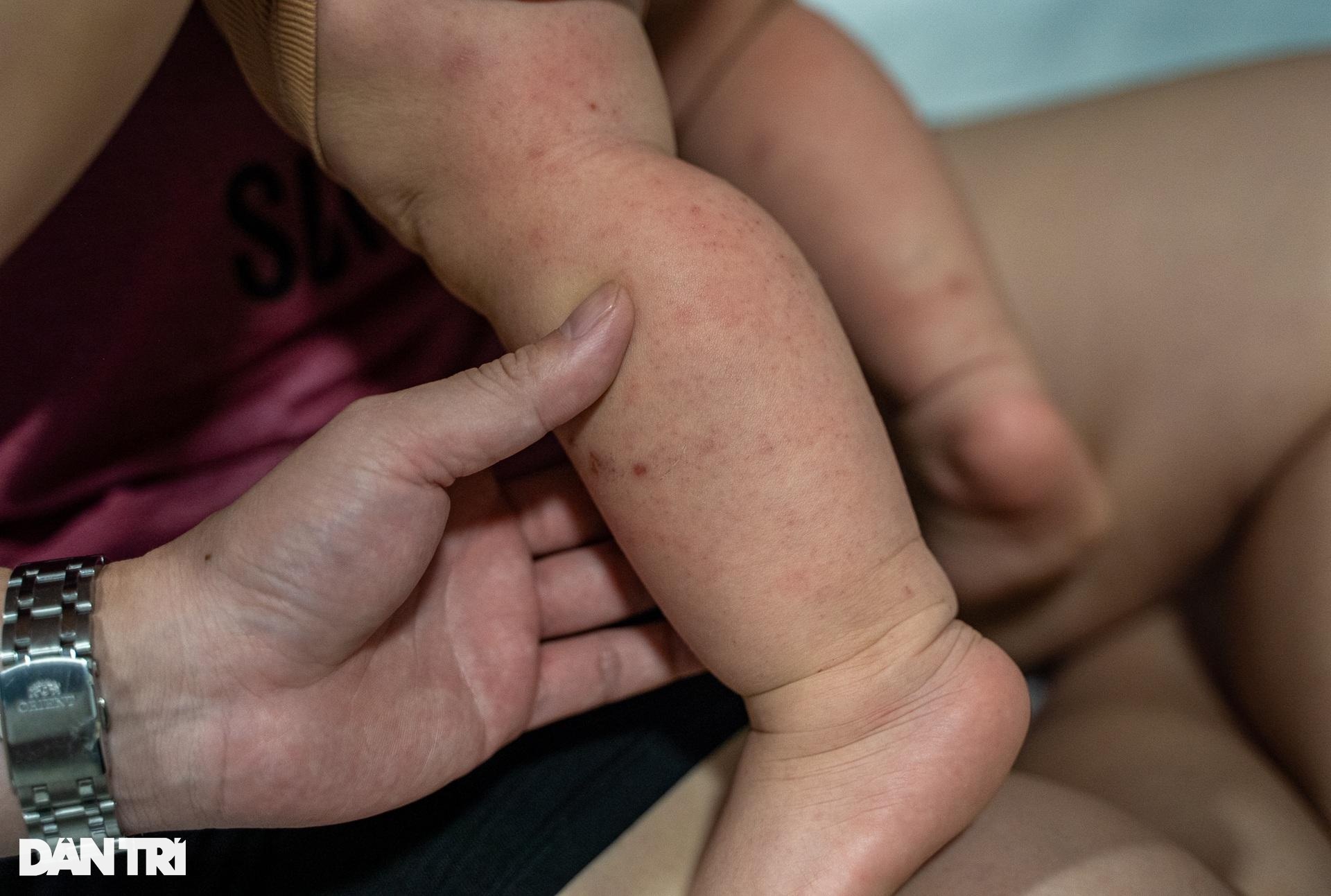 Hà Nội: Gia tăng trẻ nhập viện vì Covid-19, có tình trạng đồng nhiễm - 12